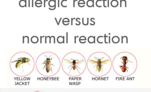 bee sting reaction