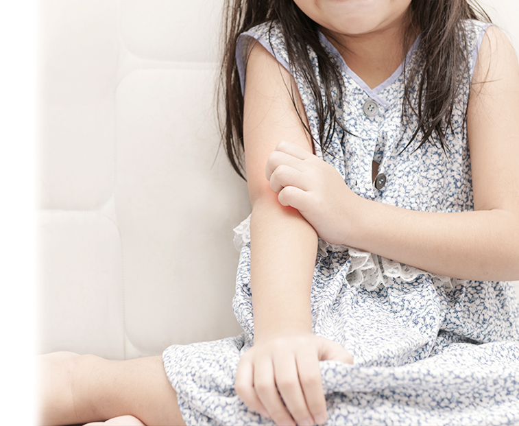 Eczema is a common allergic skin disease that often starts in childhood.